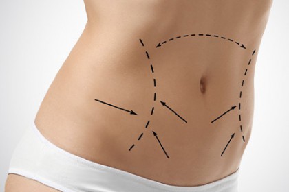 Tummy Tuck