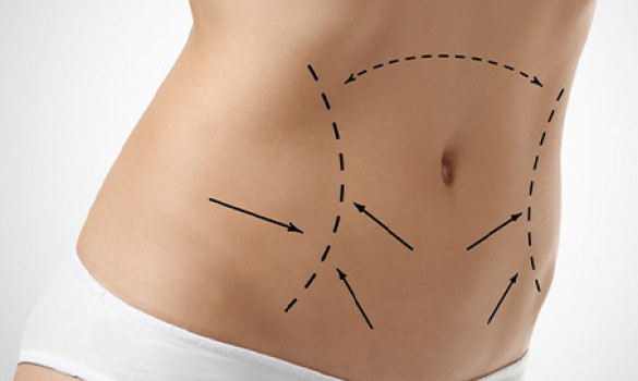 Abdominoplastie