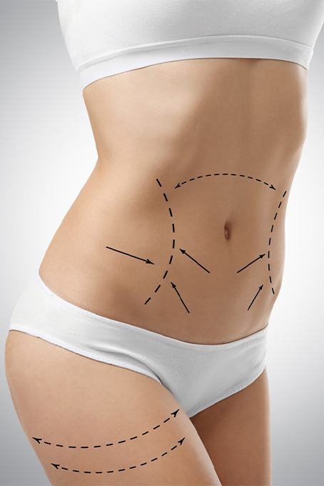 Tummy Tuck