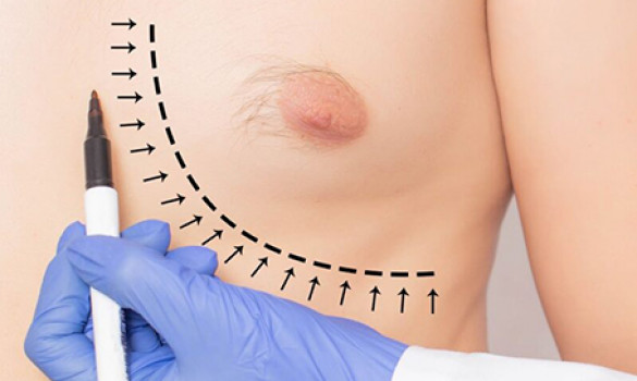 Gynecomastia